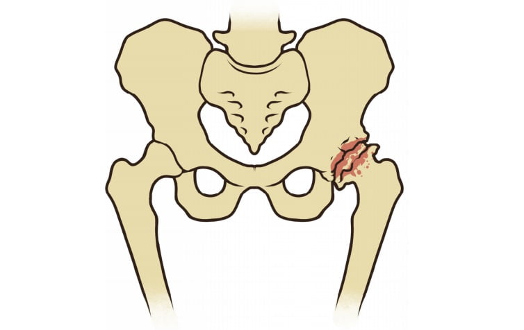 Conheça causas e tratamentos da Artrose de Quadril, com ortopedista do Imot