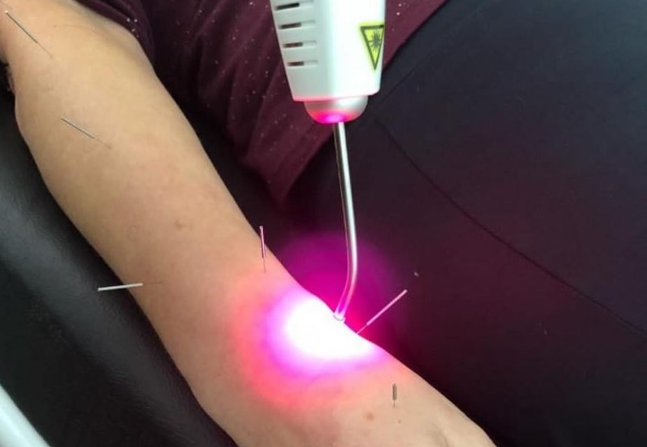 Acupuntura, um serviço do Imot para te ajudar a ter mais qualidade de vida