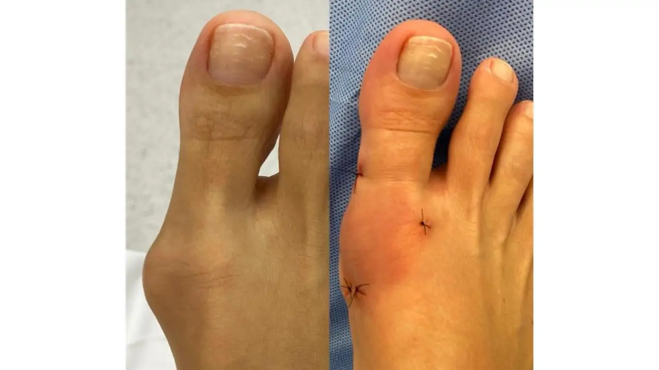 Cirurgia para acabar com joanete disponível no Imot tem pequenas incisões e rápida recuperação