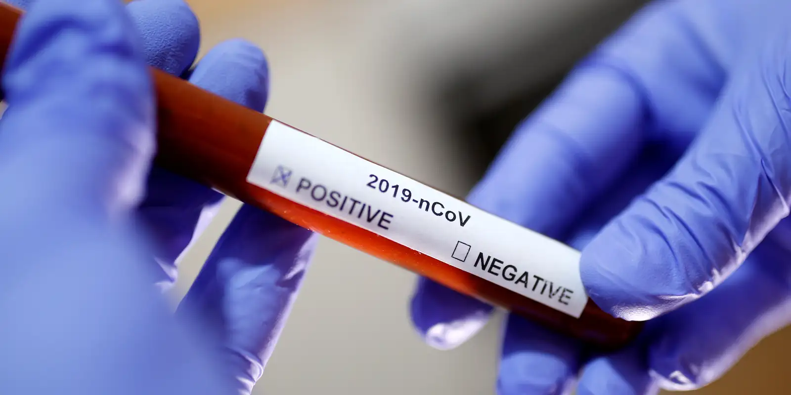 Pandemia de Covid-19 causou 22 milhões de mortes, afirma novo relatório